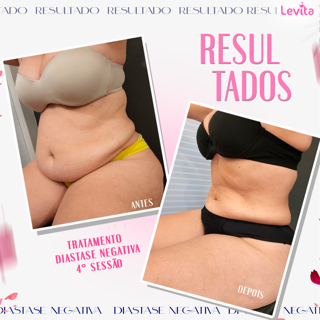 Resultado Diástase Negativa 2.0