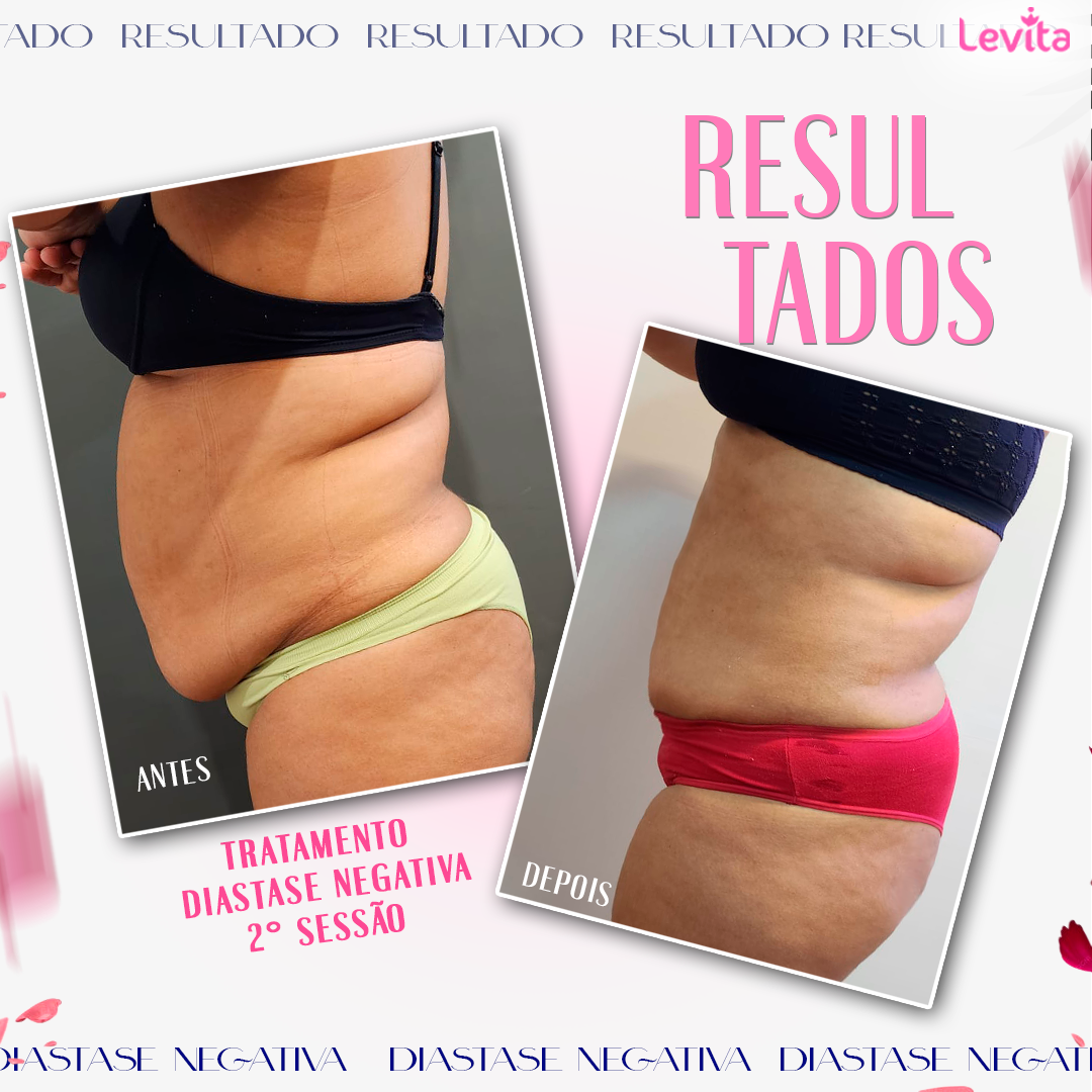 Resultado Diástase Negativa
