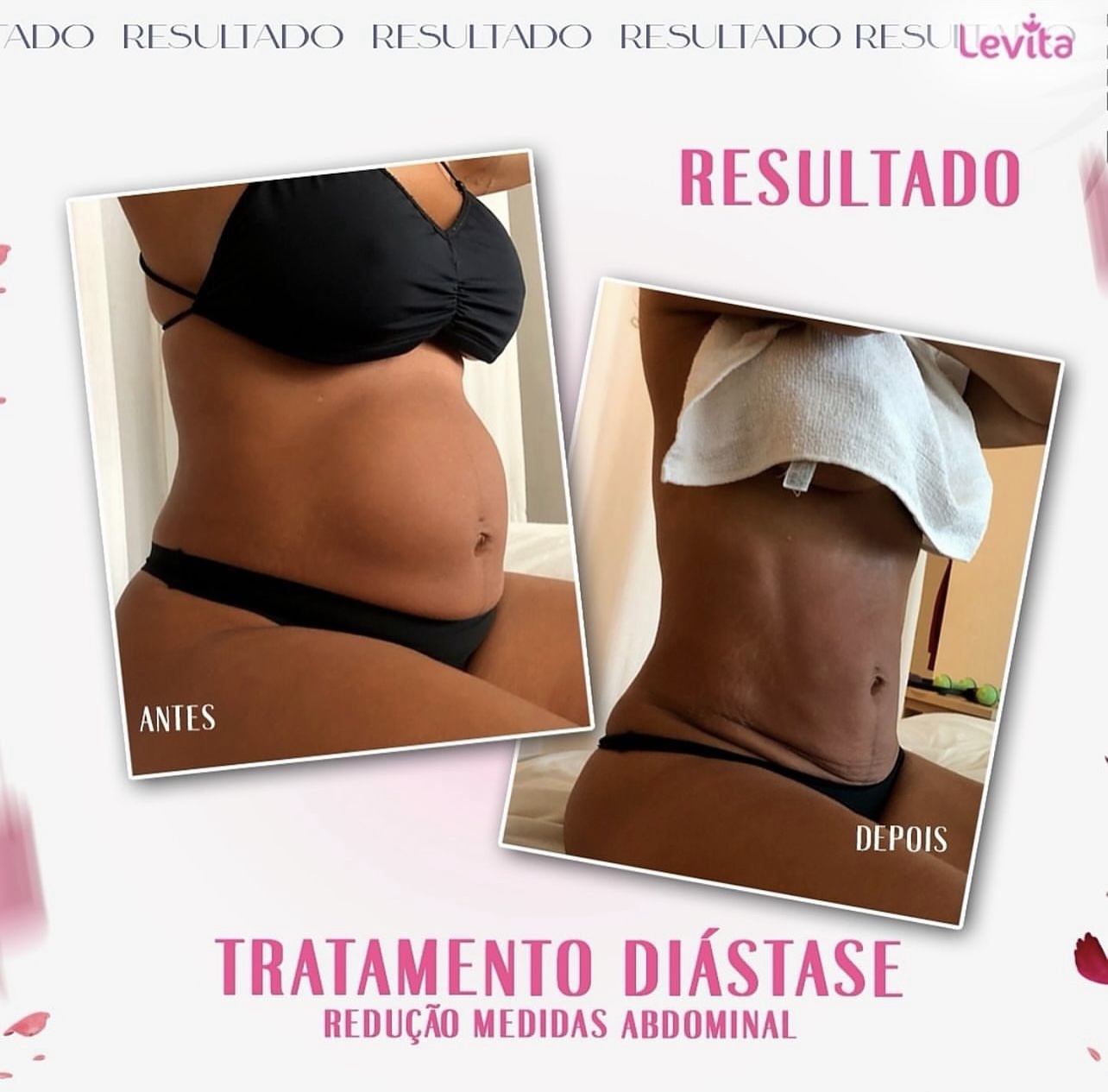 Resultado Diástase Negativa