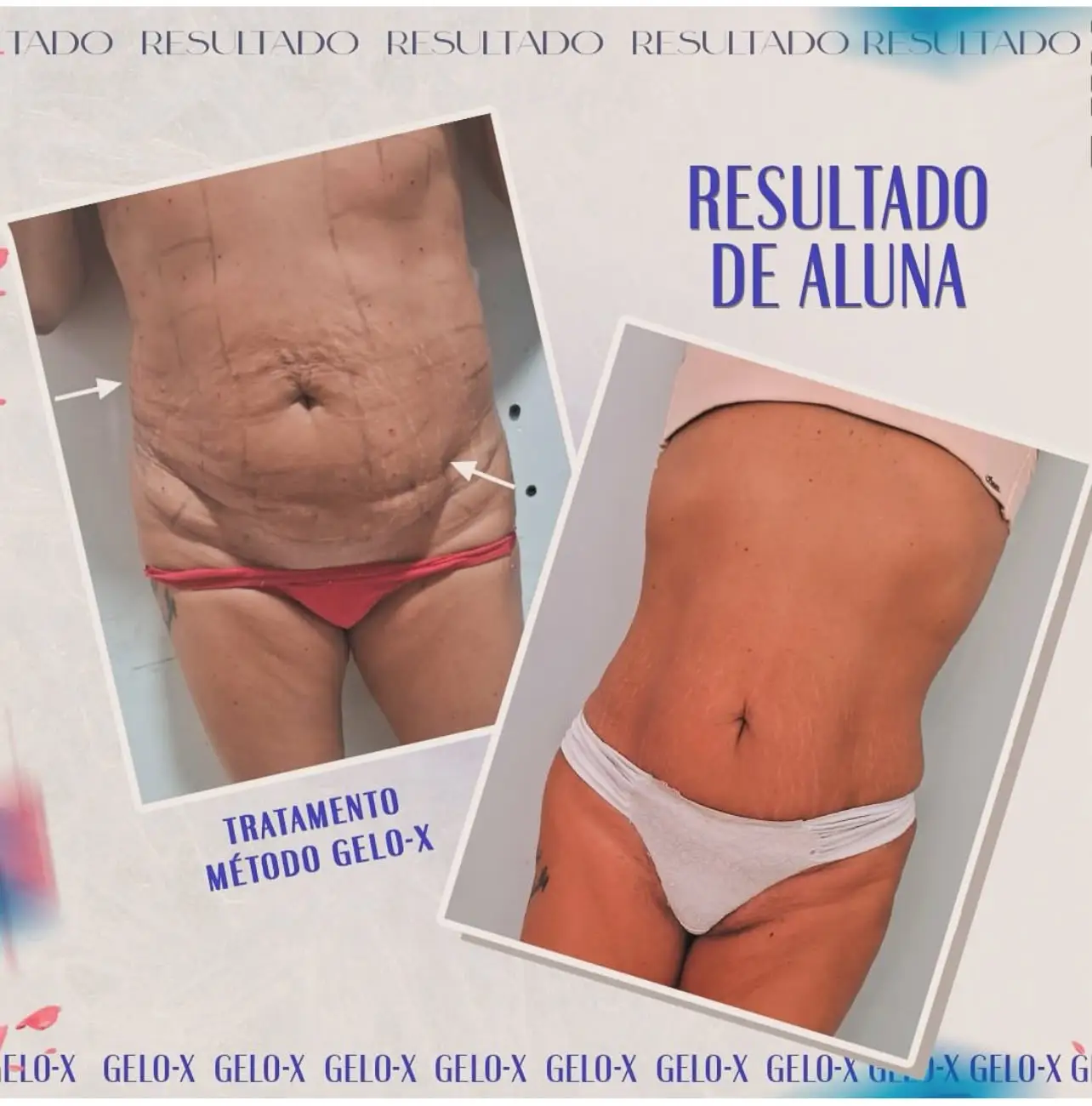 Resultado Método Gelo-X 8
