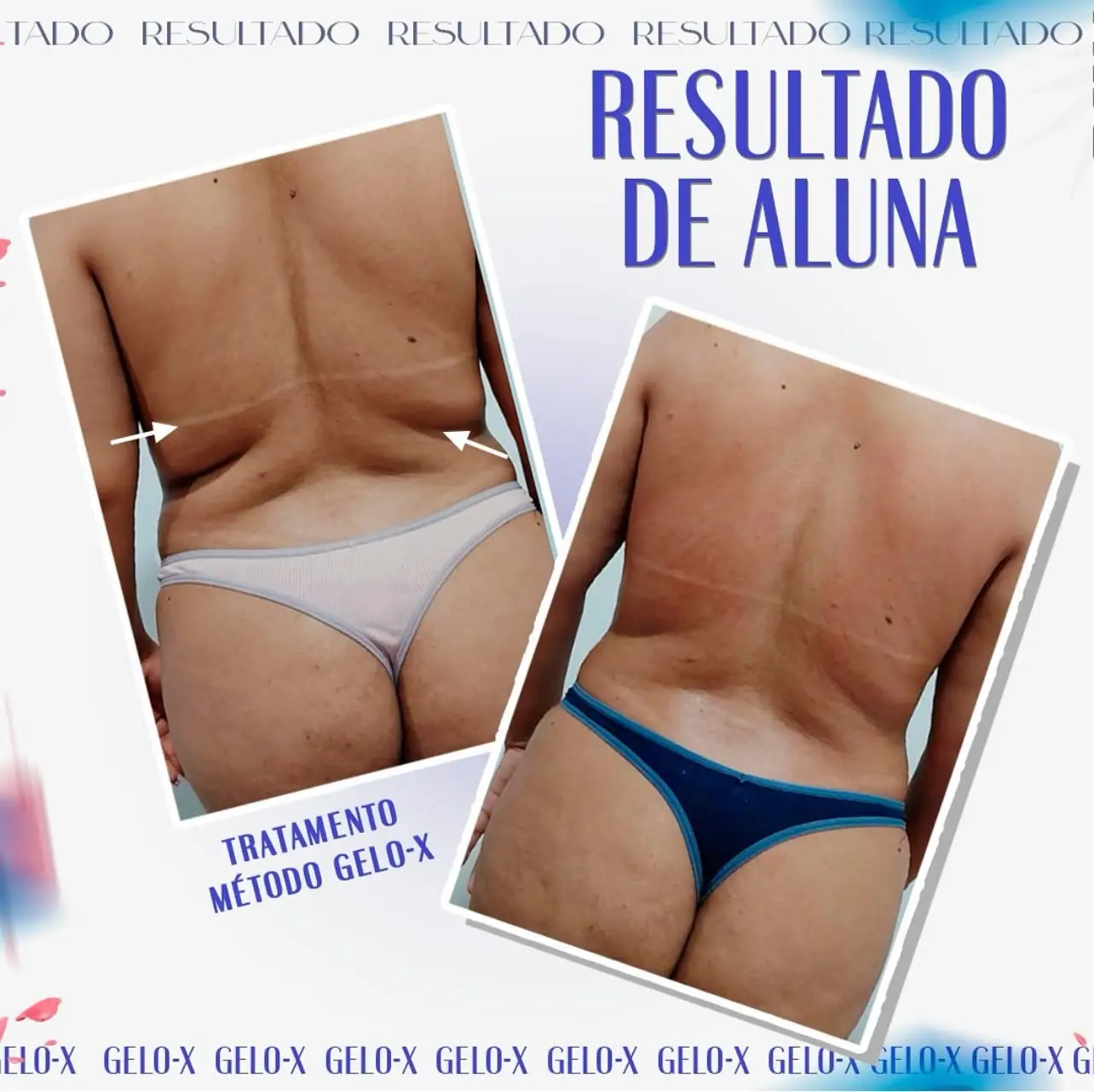 Resultado Método Gelo-X 4