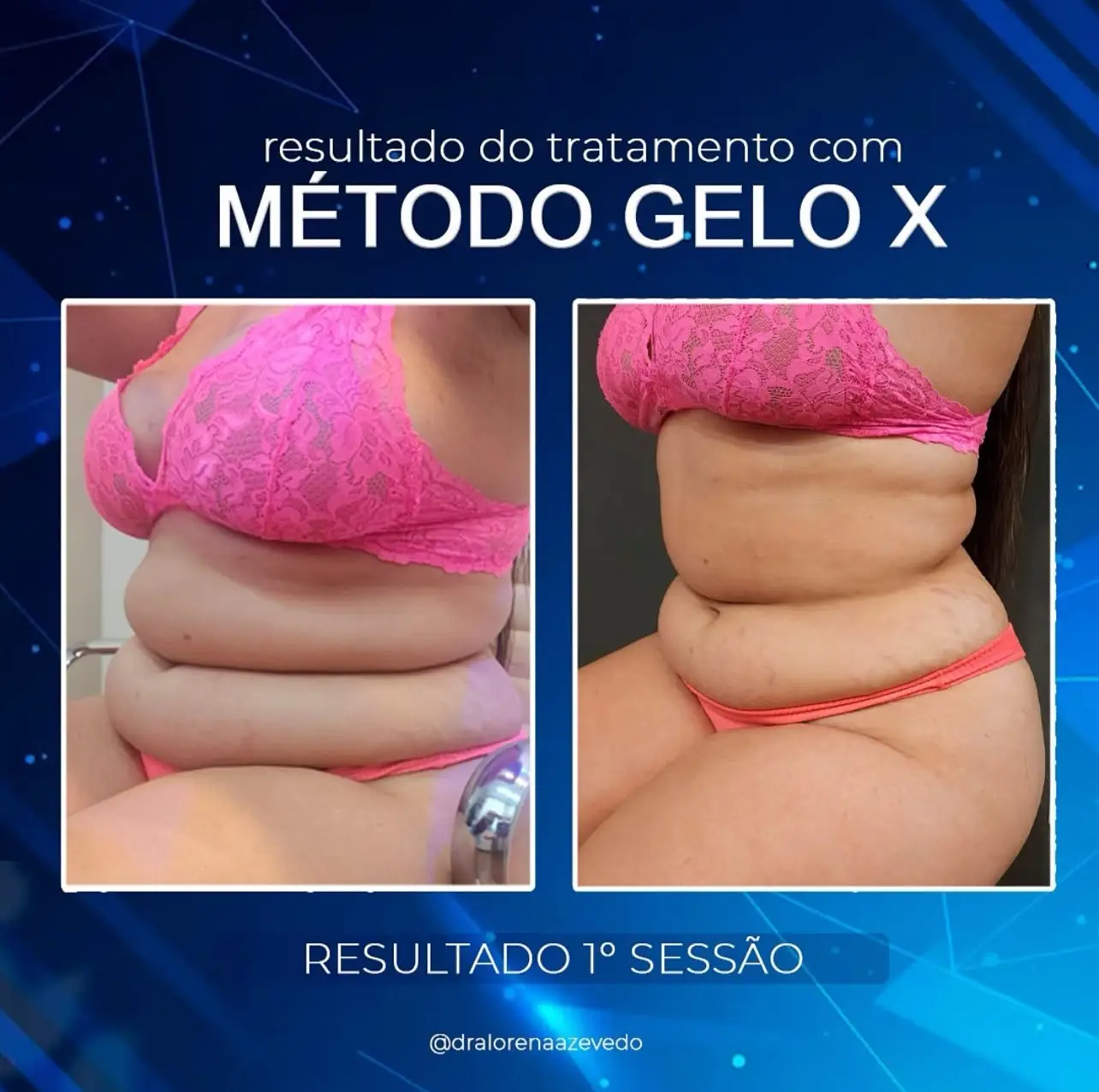 Resultado Método Gelo-X 5